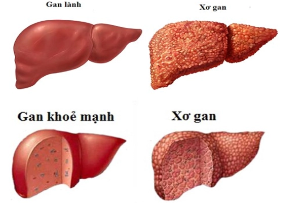 Xơ gan là biến chứng nguy hiểm của viêm gan B